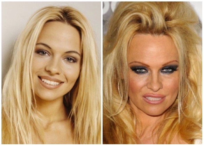 Shocking Transformations Revealed Celebrity Before And After Plastic(04)